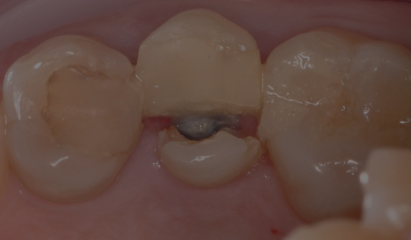 Экструзия и сохранение зуба, сломанного глубоко под десну