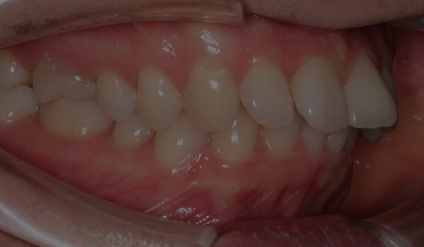 Коррекция прикуса и скученности на элайнерах (капах)