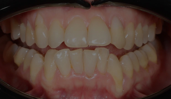 Лечение после неудачной ортодонтии