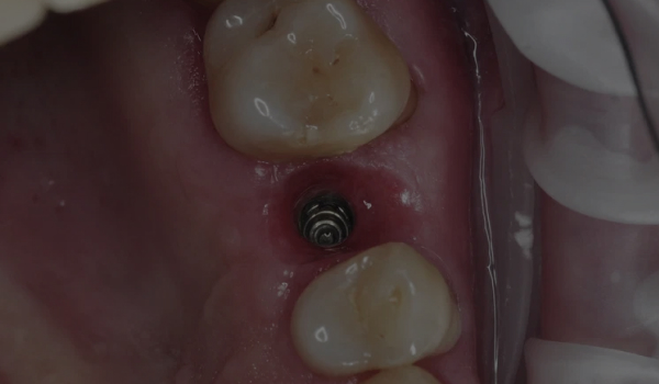 Имплантация зуба после перелома