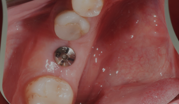 Установка импланта с пластикой десны