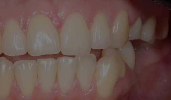 Сложный ортодонтический случай без операции