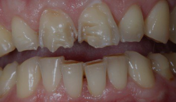 От сколов к идеальной линии улыбки