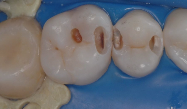 Проблема межзубных промежутков