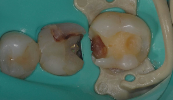 Пломба выпала — зуб спасли