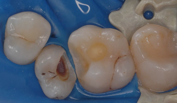 Чувствительность зубов: от причины к решению