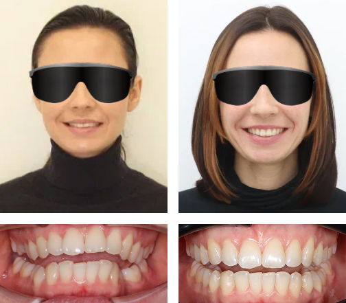 Коррекция прикуса и скученности на элайнерах (капах)