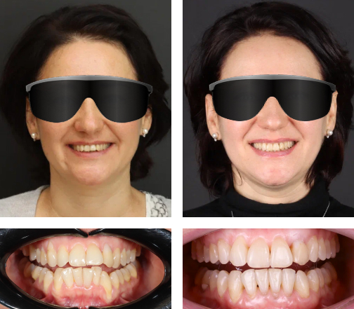 Лечение после неудачной ортодонтии