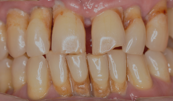 Новая опора для зубов