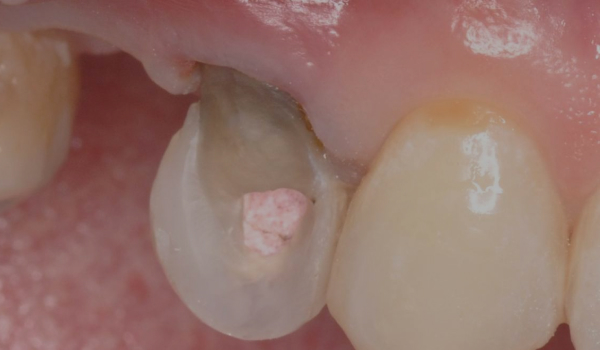 Вместо удаления сохранение зуба 