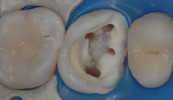 Сохранение зуба при наличии кисты, проростающей в гайморову пазуху