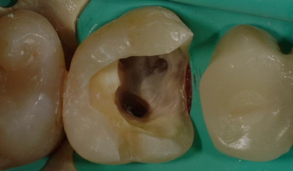 Перелечивание зуба с кистой под микроскопом